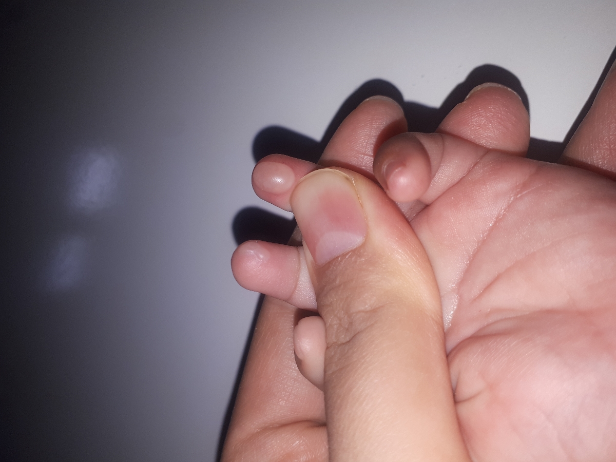 سوختگی دست نوزاد ۵ ماهه