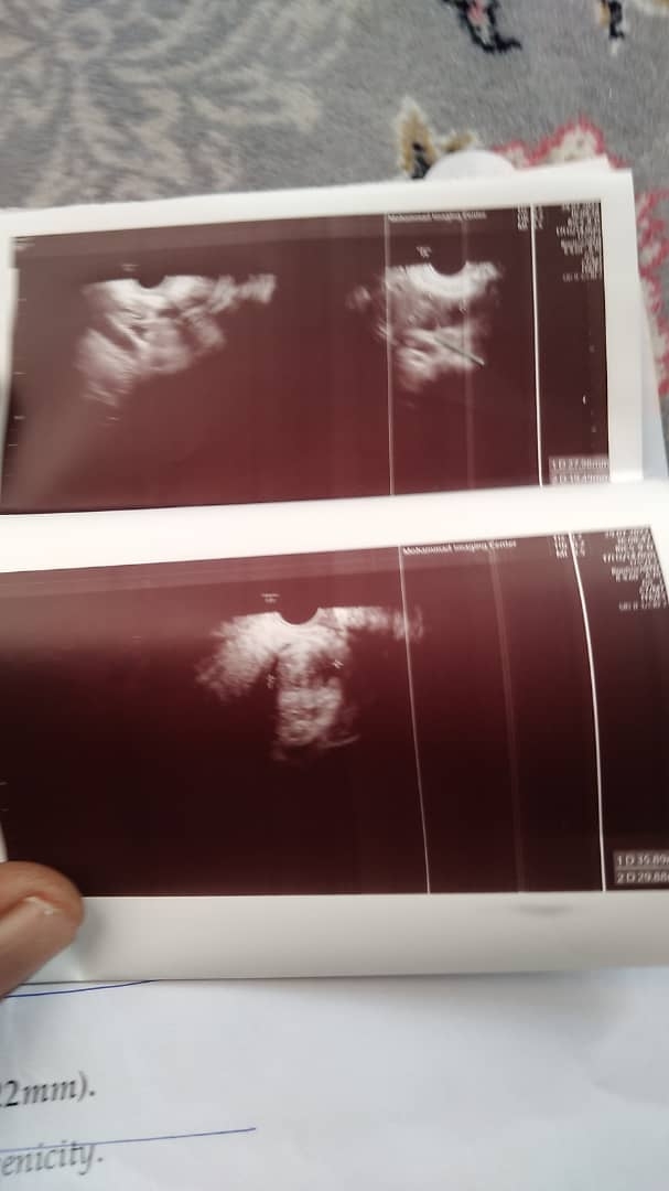 فوری لطفا تفسییر جواب نمونه برداری از رحم