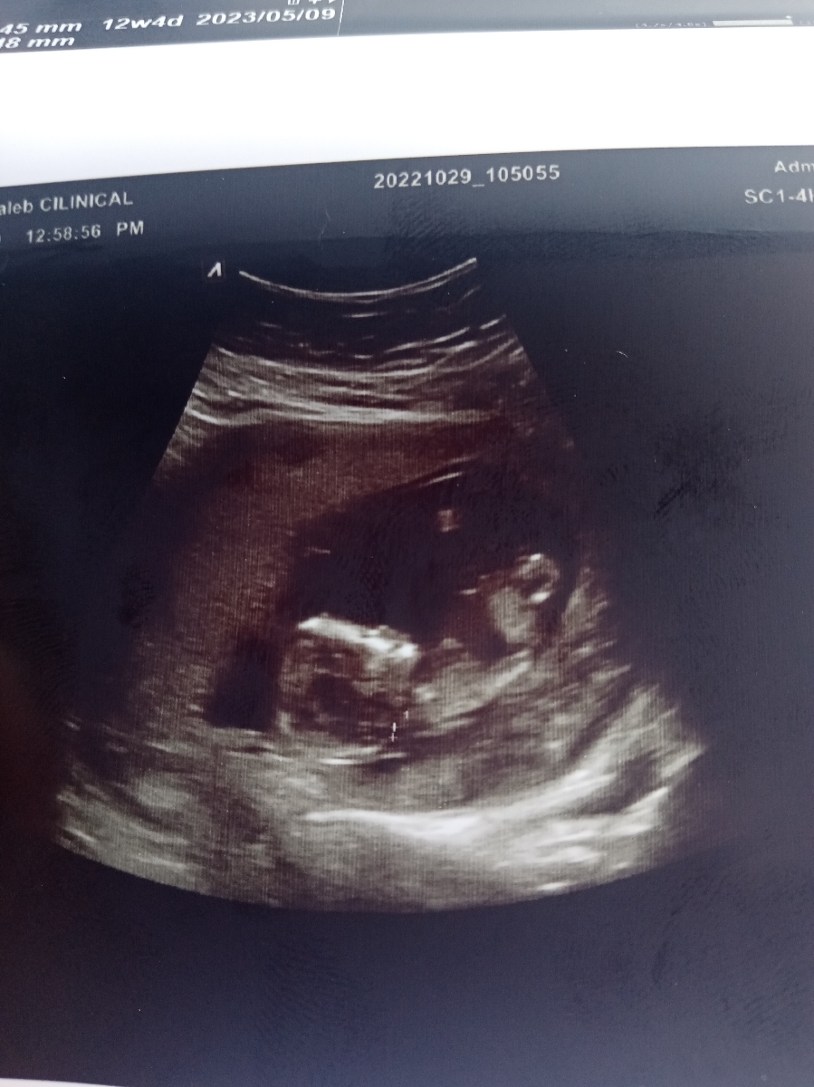 سونو آنتی و حدس جنسیت