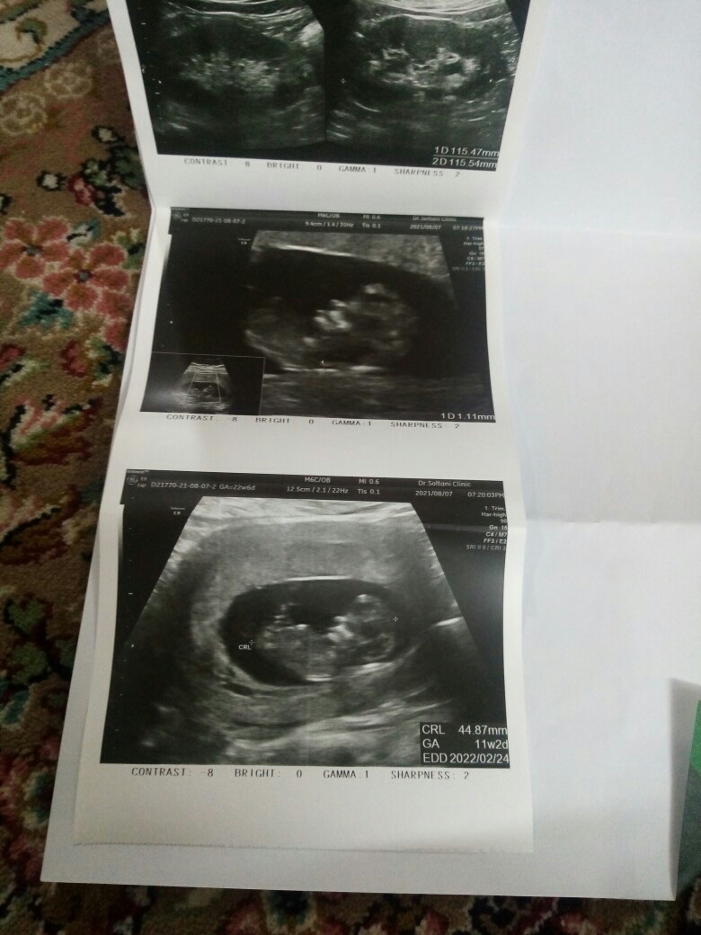 تفسیر سونوی ان تی و جنسیت نی نی چیه