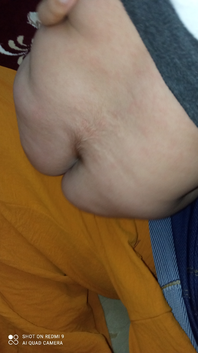 پیداشدن لکهای قرمز رو پوست بچم