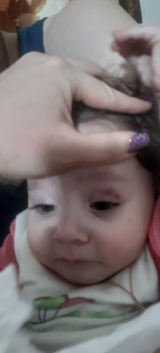 ضربه به چشم نوزاد ١١ ماهه