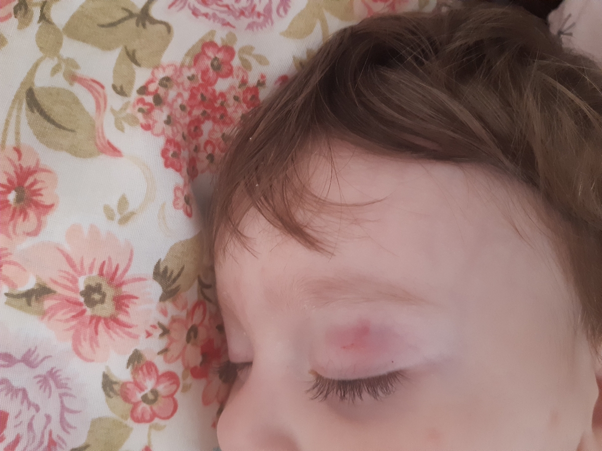 ضربه به چشم نوزاد ١١ ماهه