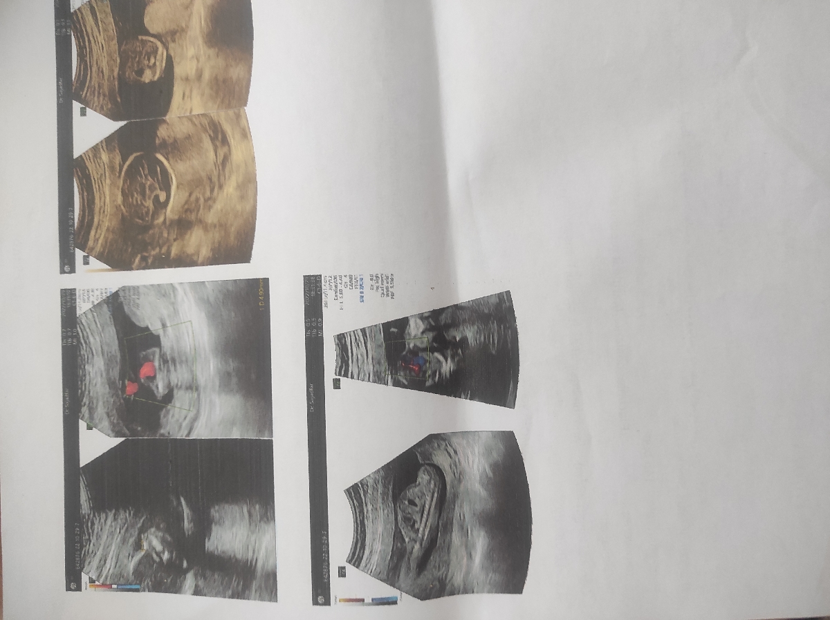 تفسیر سونو گرافی انومالی تفسیر سونو گرافی انومالی