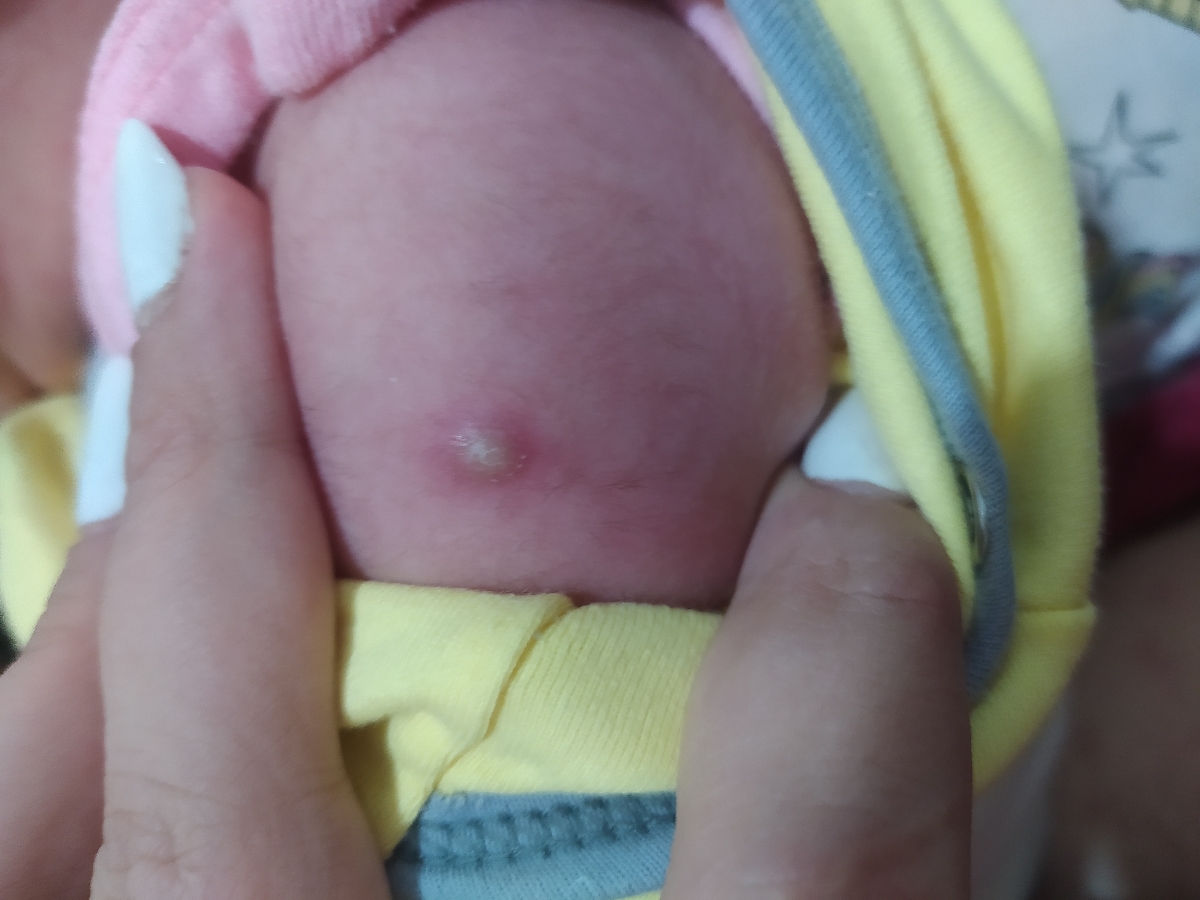 عفونت کردن جای واکسن