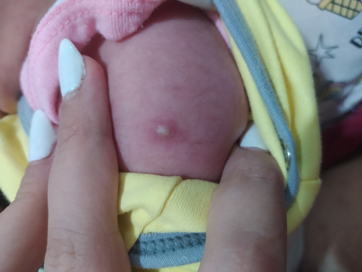 عفونت کردن جای واکسن