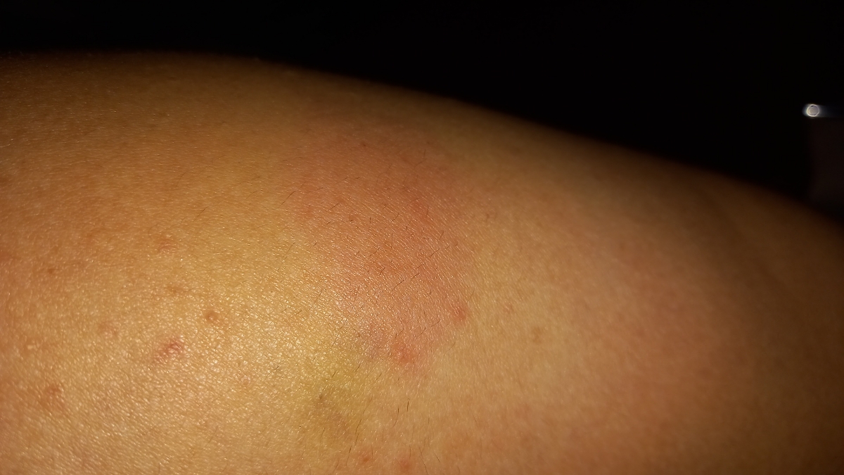 تزریق واکسن آنفولانزا و عوارض تزریق واکسن آنفولانزا و عوارض