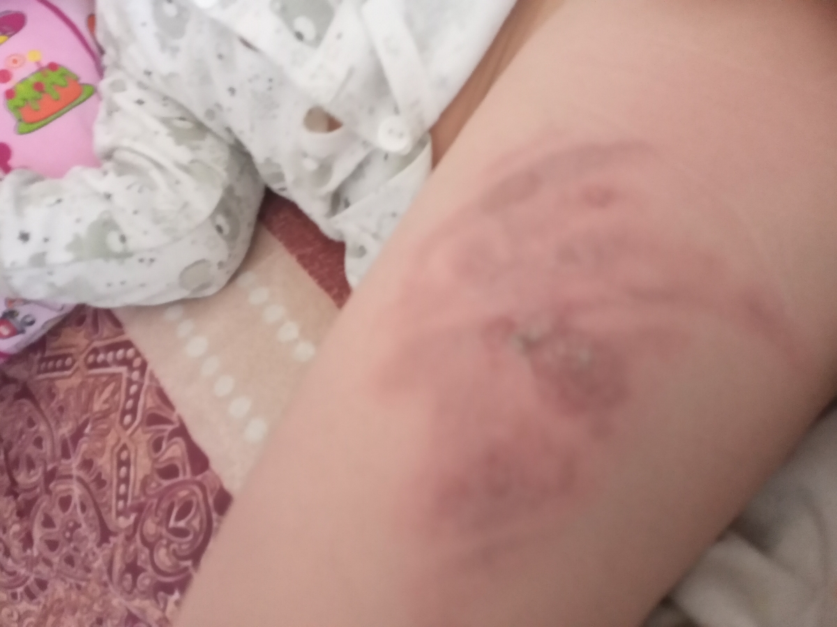 این  روز اول سوختگی هس با دست خاروندش التهابش بیشتر کرد