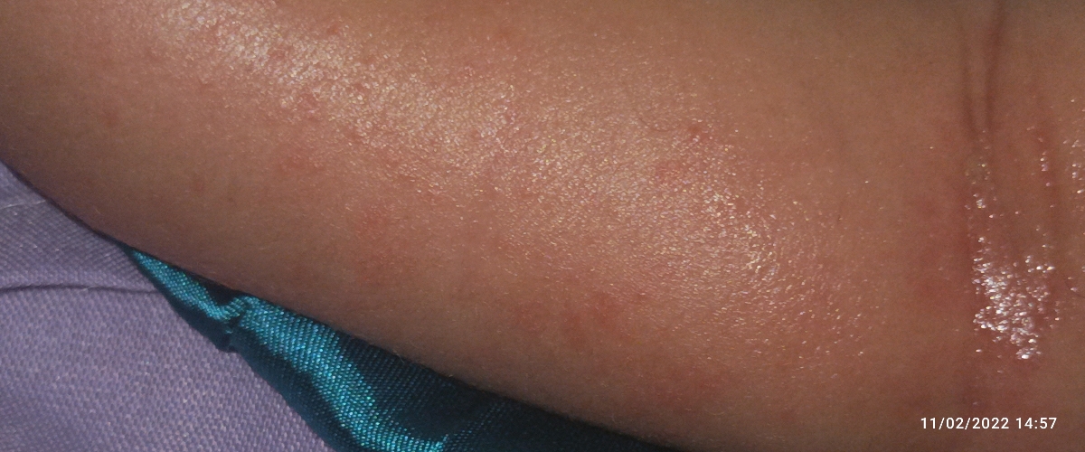 جوش ریز قرمز یا دونه های قرمز جوش ریز قرمز یا دونه های قرمز