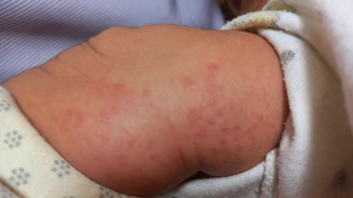 پودر امپرازول و حساسیت