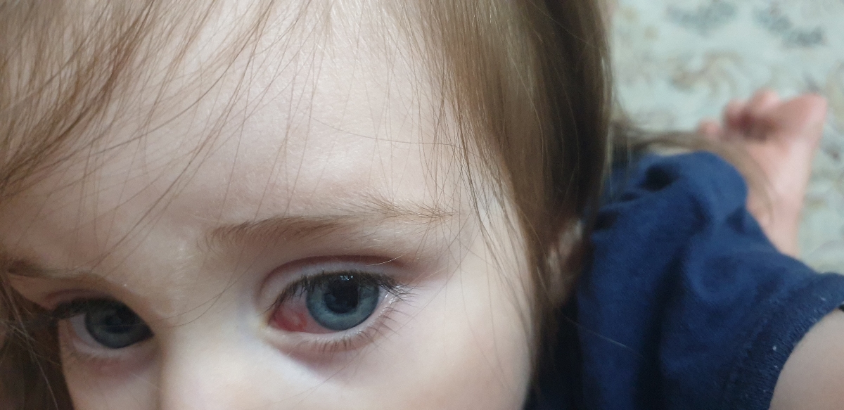 این هم عکس چشمش.قرمزیش بیشتر از خود عکسه