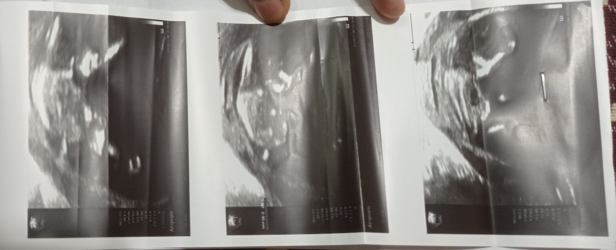 جواب آزمایش nt و سونو nt لطفا تفسیرش کنید خوبه ؟