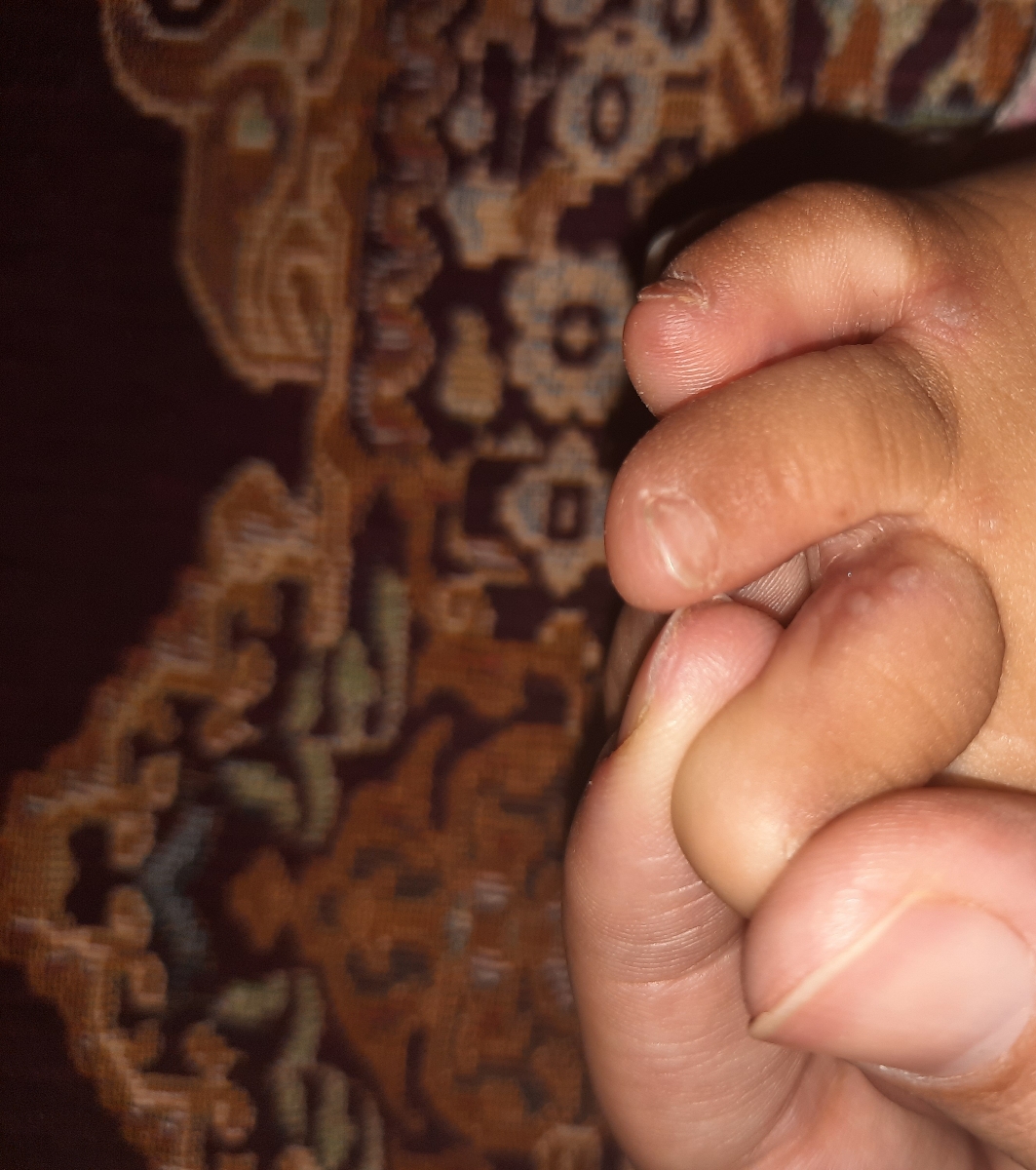 نگرانم😔تاول و دونه روی پای دخترم نگرانم😔تاول و دونه روی پای دخترم