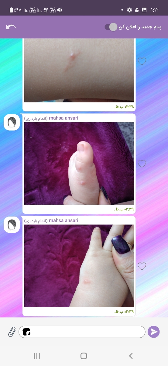 نگرانم😔تاول و دونه روی پای دخترم نگرانم😔تاول و دونه روی پای دخترم