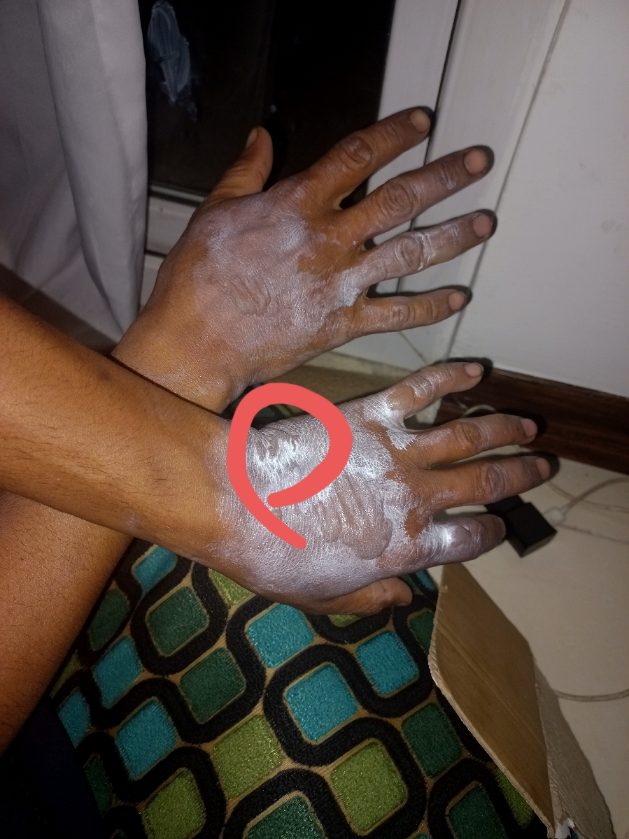 این عکس قبل از سوراخ کردن تاول ها بود و اونی خط کشیدم عفونت کرده این عکس قبل از سوراخ کردن تاول ها بود و اونی خط کشیدم عفونت کرده