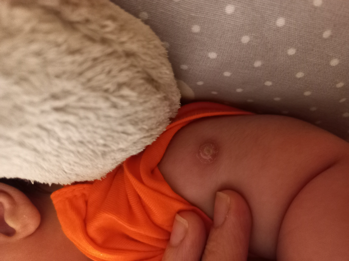 مراقبت های بعد از چرکی شدن واکسن بدو تولد چیه؟