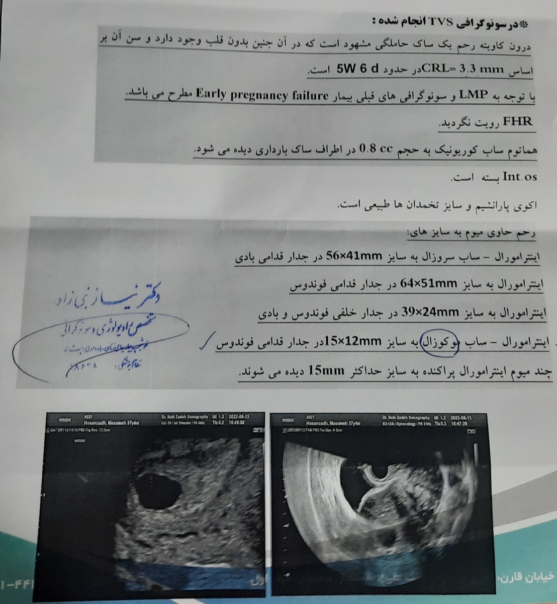 فیبروم ساب موکوزال و تشکیل نشدن قلب فیبروم ساب موکوزال و تشکیل نشدن قلب