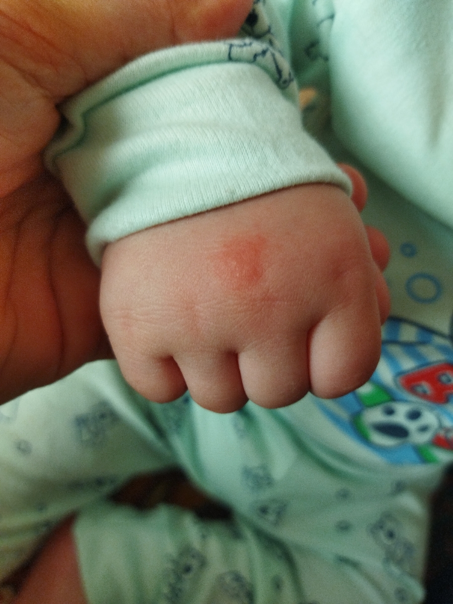 دست پسرم از این دونه های قرمز زده روی کمرش و صورتش هم هست