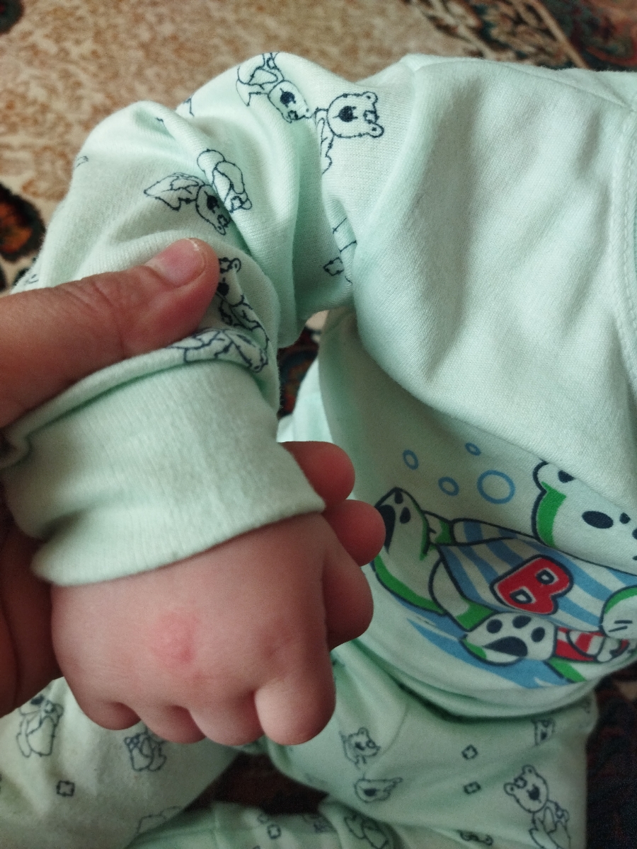 دست پسرم از این دونه های قرمز زده روی کمرش و صورتش هم هست