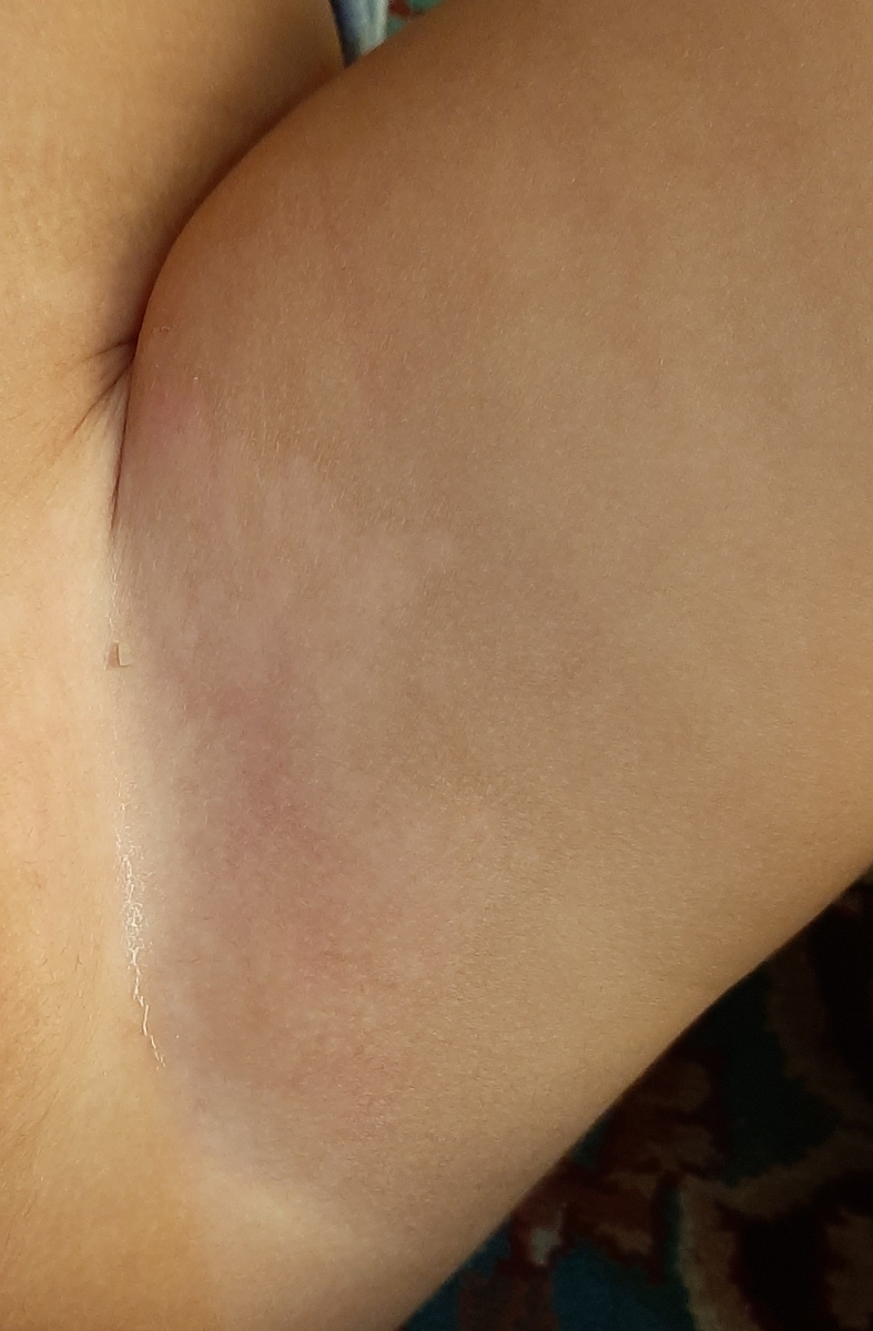 لکه های سفید روی پوست پسرم بعد از خوب شدن ادرار سوختگی شدید لکه های سفید روی پوست پسرم بعد از خوب شدن ادرار سوختگی شدید