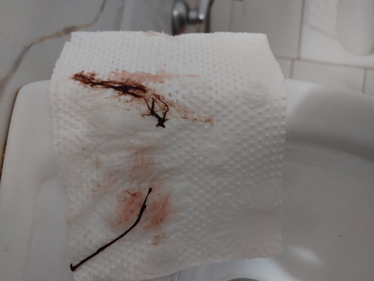 لکه بینی و دفع لخته در روز هفتم از هفته ششم با عکس لکه بینی و دفع لخته در روز هفتم از هفته ششم با عکس