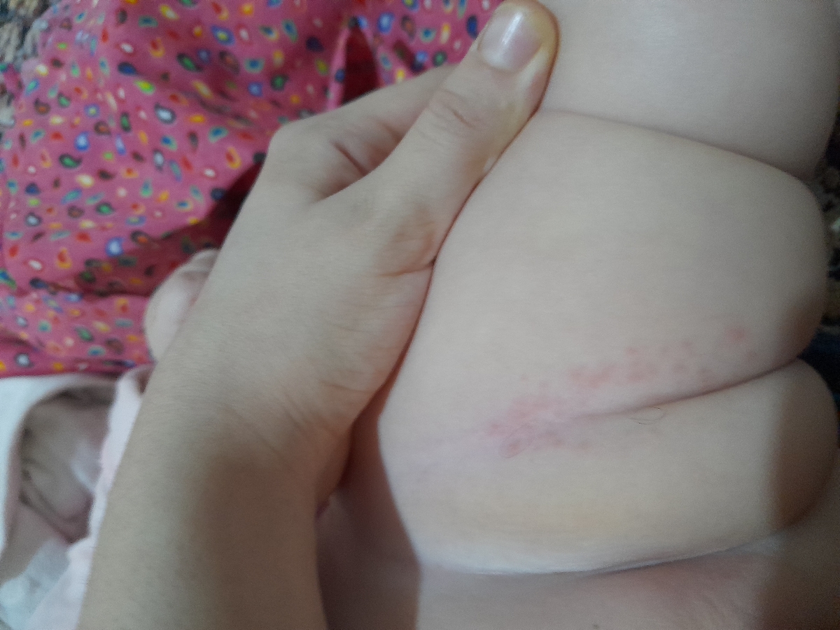 جوش زدن پای نوزاد ۸ماهه جوش زدن پای نوزاد ۸ماهه