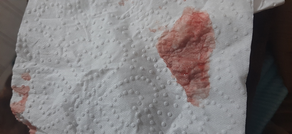 ترشحات شدید درهفته ۱۱😣 ترشحات شدید درهفته ۱۱😣