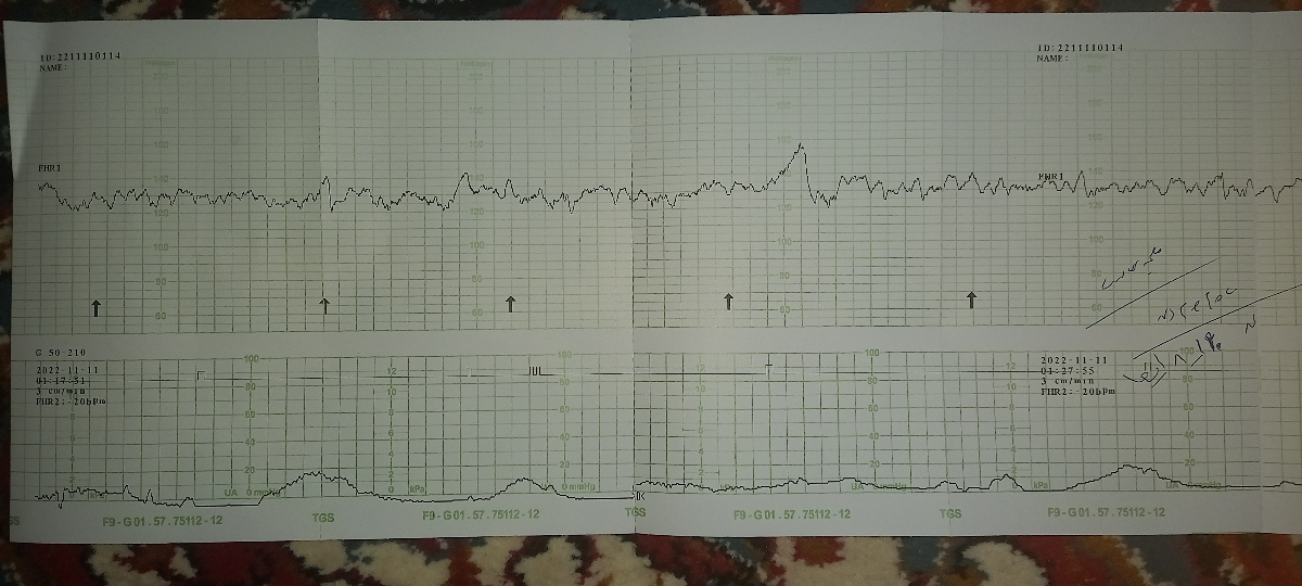 انقباض و درد ۳۱ هفتگی