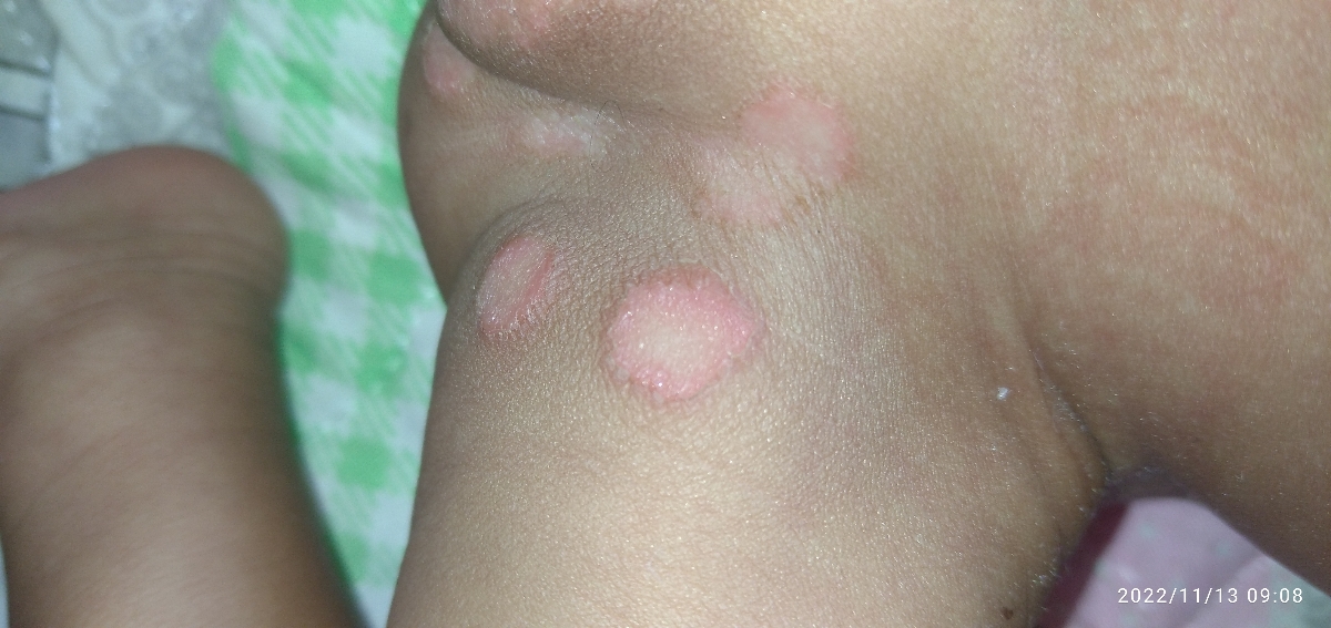 قرمز وزخم شدن پای دخترم