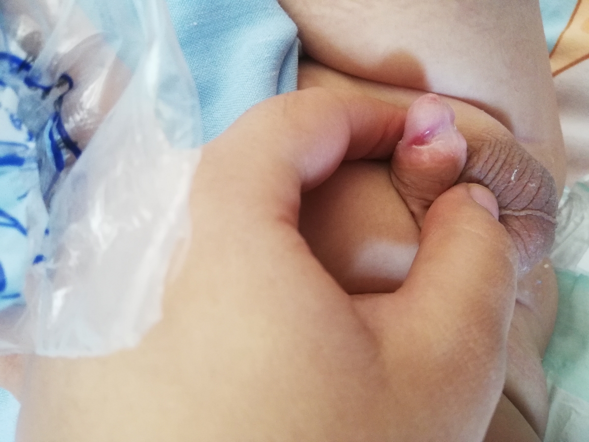 ختنه نوزاد ۳۵ روزه