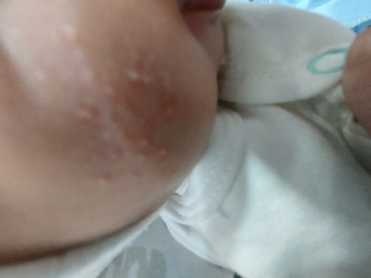 جوش زدن لپ های نوزاد ،، خوب نشدن زخم ناف