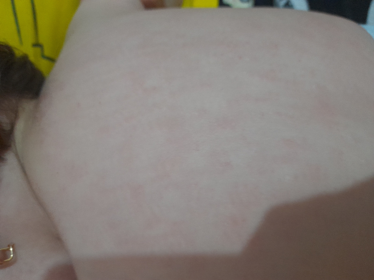 کهیر روی بدن دخترم بعد از چند روز تب