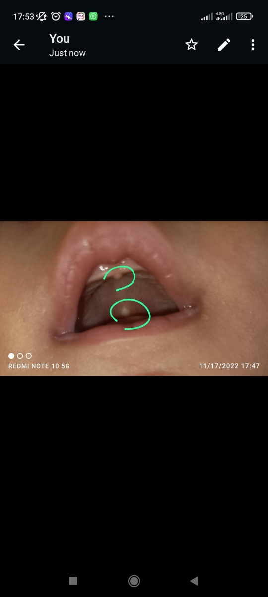 جوش سفید در سقف دهان جوش سفید در سقف دهان