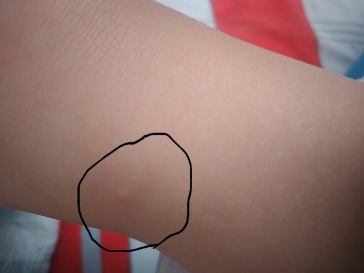 دانه های ریز روی پوست دخترم