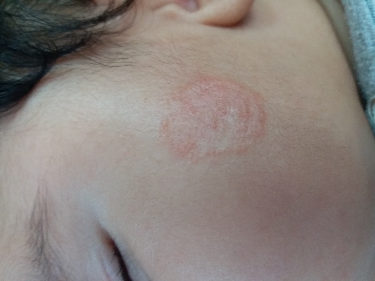 اگزمای پوست صورت نوزاد سه ماهه
