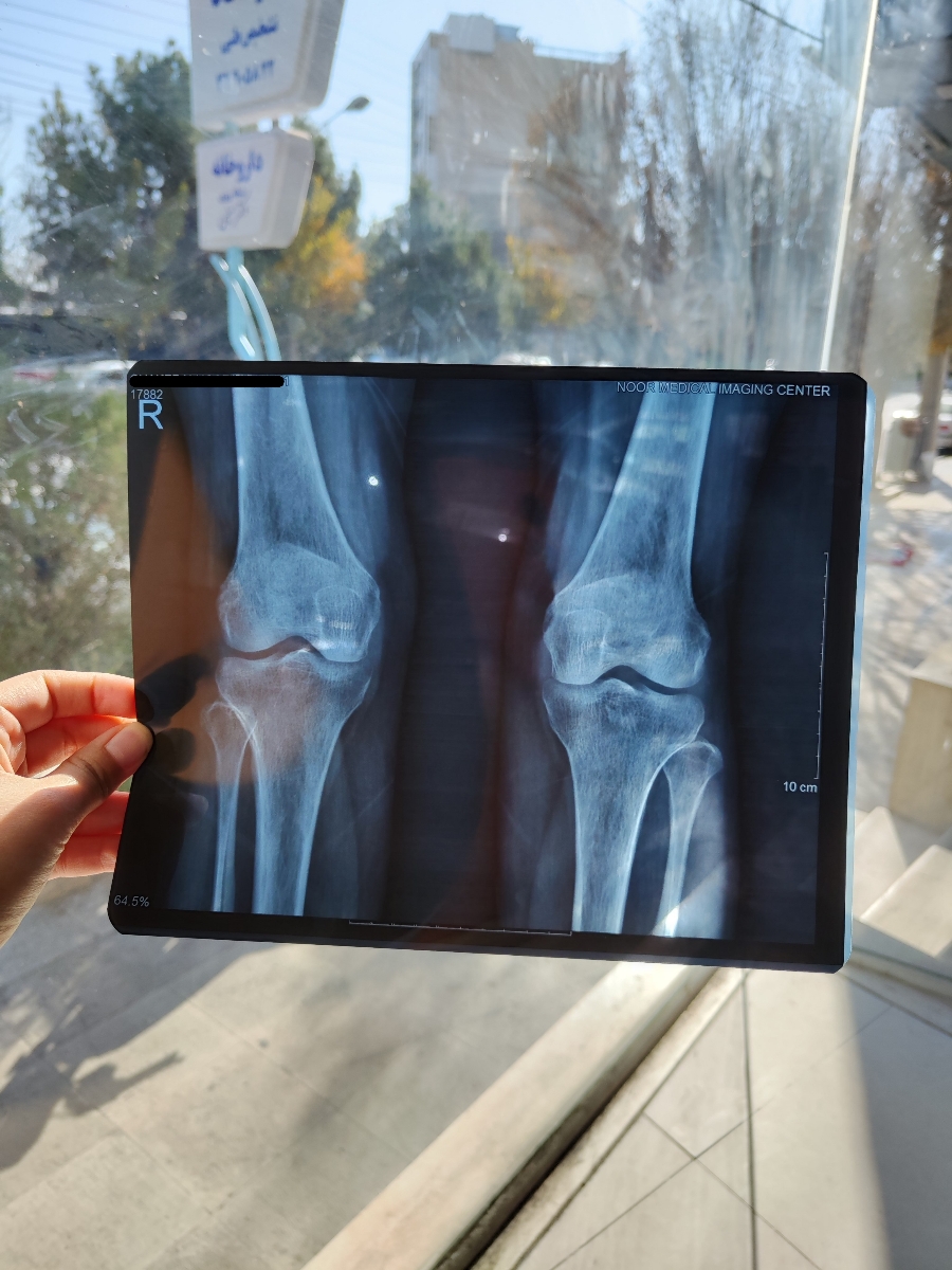 تفسیر MRI کمر و عکس زانو تفسیر MRI کمر و عکس زانو