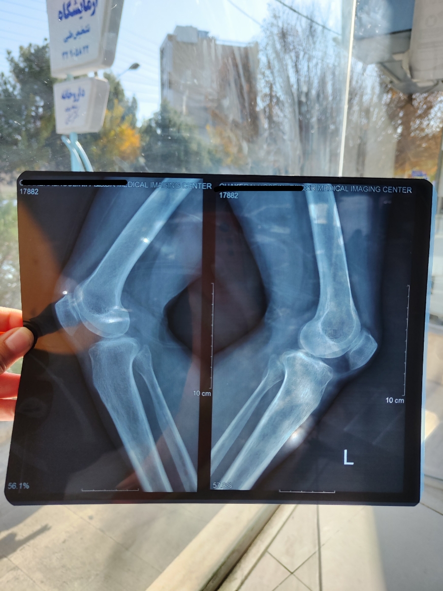 تفسیر MRI کمر و عکس زانو تفسیر MRI کمر و عکس زانو