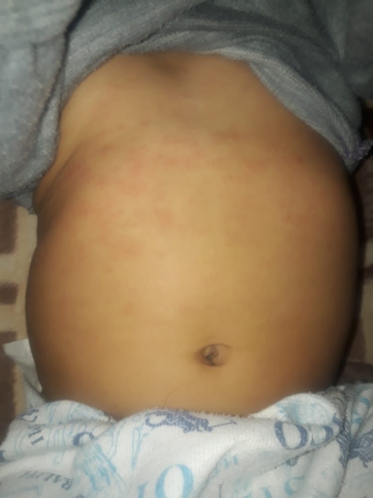 سلام خانم دکتر و دوستان عزیز روی شکم پسر هفت ماهم این دونه ها در اومده سلام خانم دکتر و دوستان عزیز روی شکم پسر هفت ماهم این دونه ها در اومده