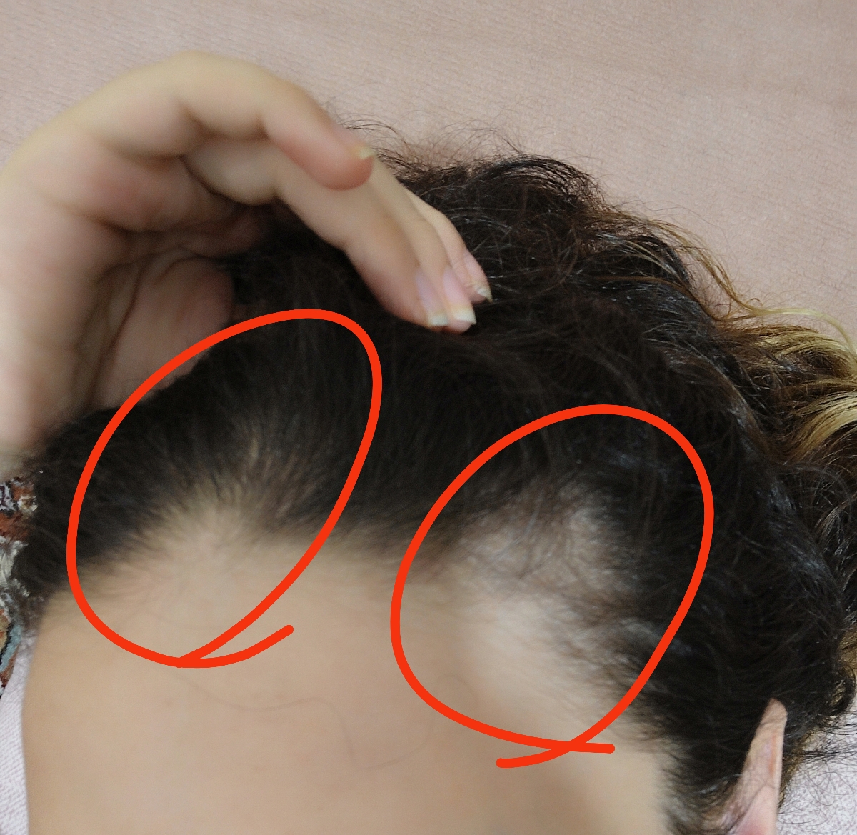 ریش موی سر بعد زایمان