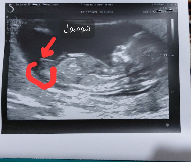 بفرما .با رسم شکل
شومبول و زیر شومبول بفرما .با رسم شکل
شومبول و زیر شومبول