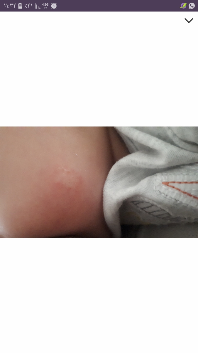 اگزمای صورت نوزاد ۶ماهه