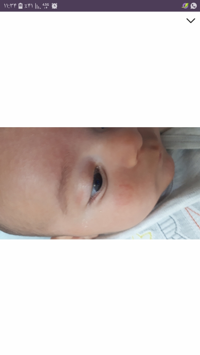 اگزمای صورت نوزاد ۶ماهه