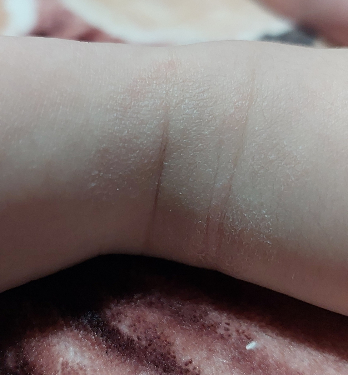 خشکی مدام پوست صورت و مچ پا خشکی مدام پوست صورت و مچ پا