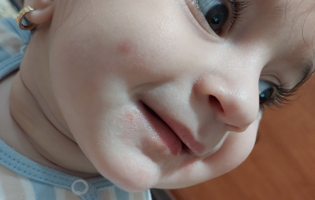 خشکی مدام پوست صورت و مچ پا خشکی مدام پوست صورت و مچ پا