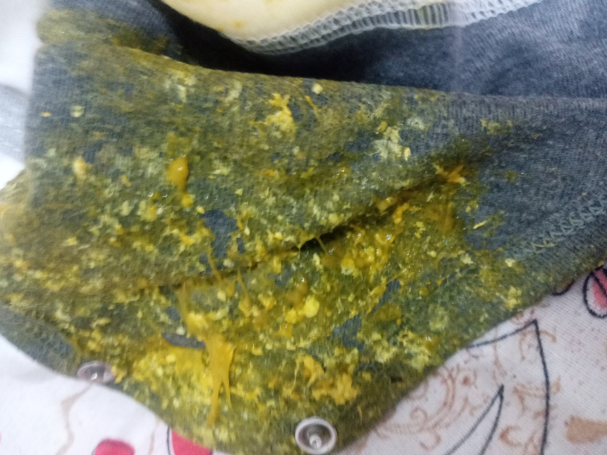 تکه های سفید شیر واسهال شدن نوزاد چهار ماهه