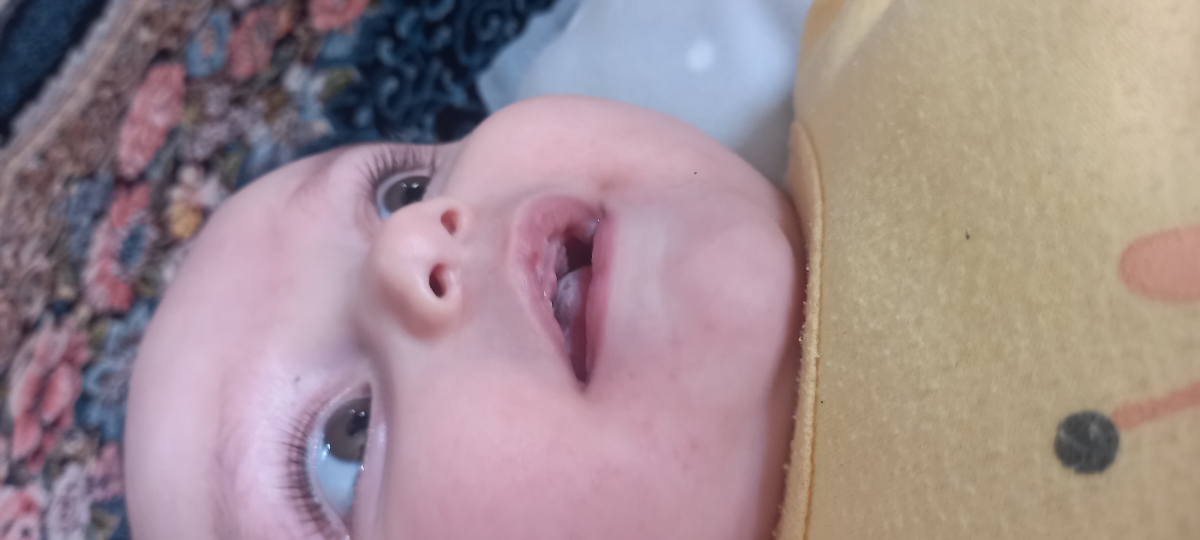 سفید شدن زبون سفید شدن زبون