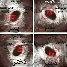 این عکس سونوی دخترپسر