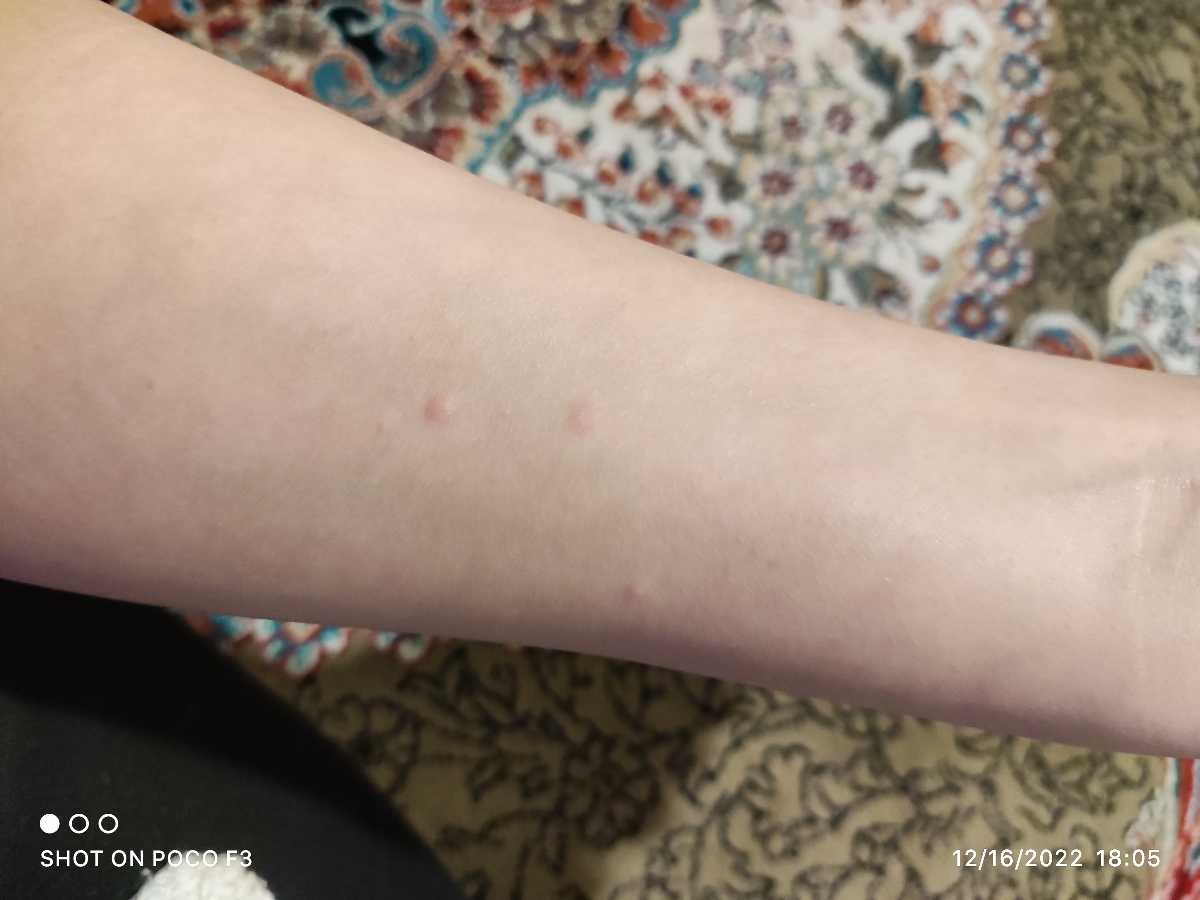 اولش میسوزه. بعدش اینا پیدا میشه یکم بعدش بزرگ میشه الان میفرستم ببین اولش میسوزه. بعدش اینا پیدا میشه یکم بعدش بزرگ میشه الان میفرستم ببین