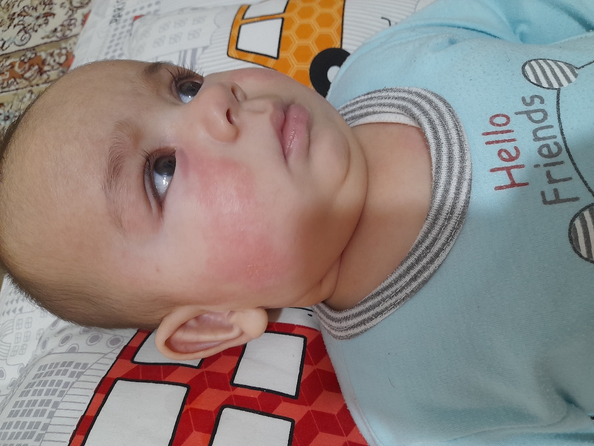قرمز شدن صورت نوزاد ۴ماه ونیم قرمز شدن صورت نوزاد ۴ماه ونیم