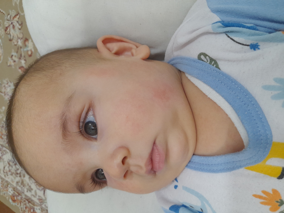 ببینیدخانم دکتر
فقط صبح ساعت ۱۱ یک لایه پماد زدم وتاالان چیزی نزدم
این عکس همین الان هست ببینیدخانم دکتر
فقط صبح ساعت ۱۱ یک لایه پماد زدم وتاالان چیزی نزدم
این عکس همین الان هست
